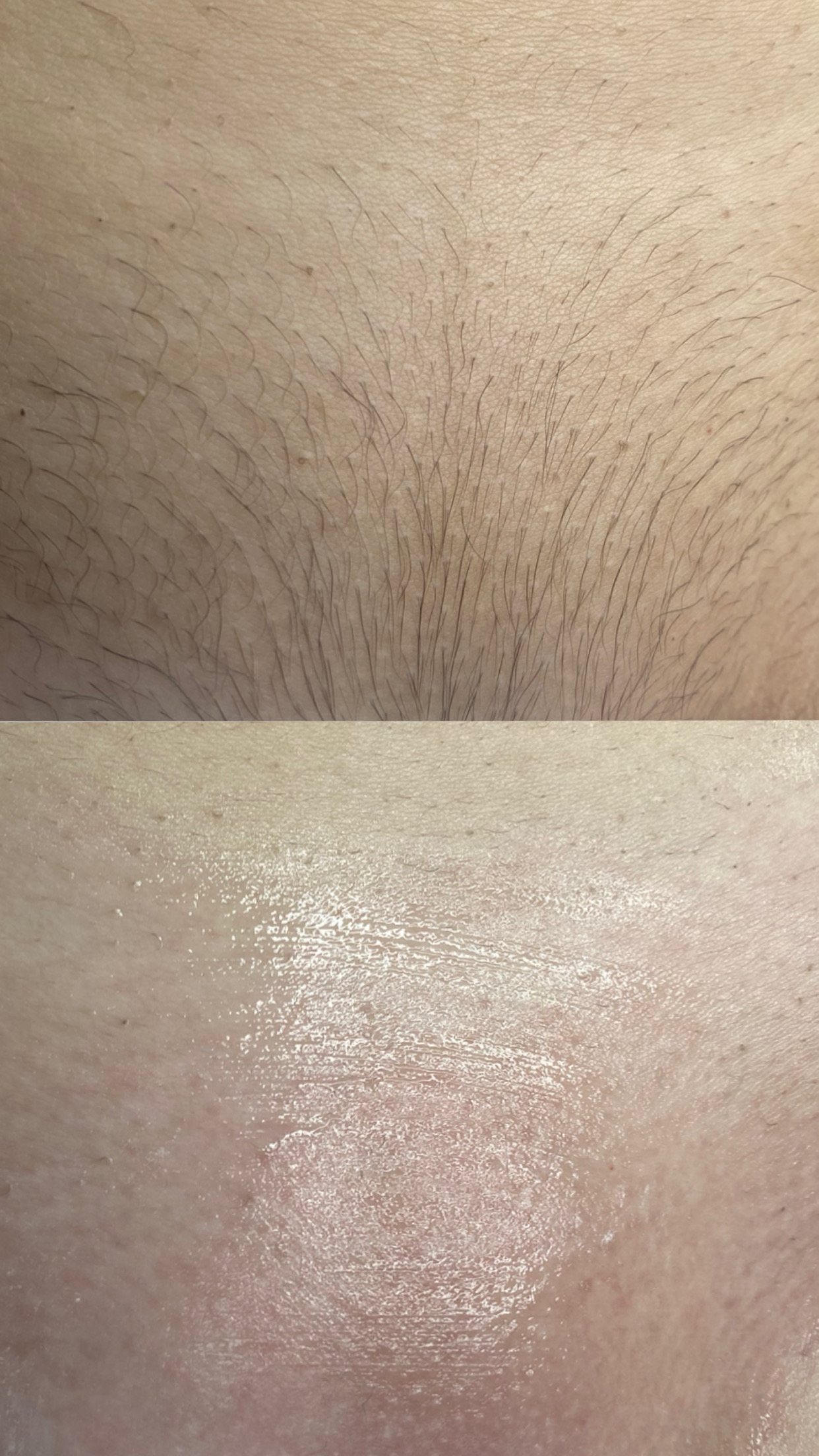 Depilacja bikini w Warszawie – efekt przed i po zabiegu