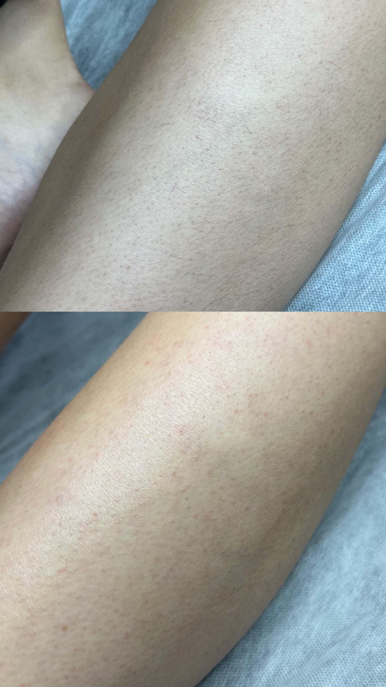 Depilacja nóg w Warszawie – efekt przed i po zabiegu